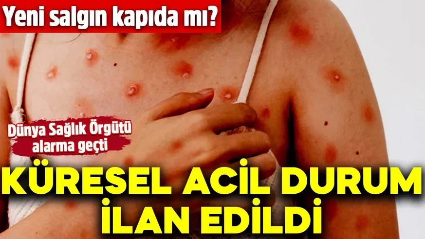 DSÖ maymun çiçeği virüsü için küresel halk sağlığı acil durumu ilan etti!