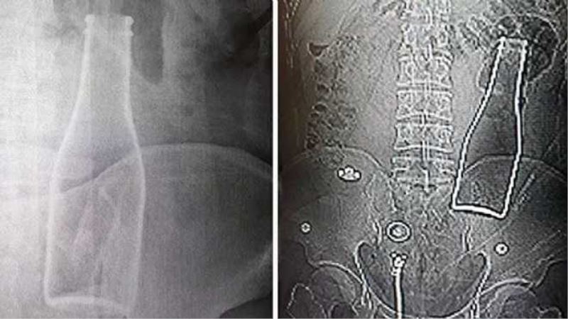 Karın ağrısı şikâyetiyle gittiği hastanede, vücudunda şişe olduğu ortaya çıktı